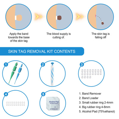 Skin Tag Removal Tool Skin Removing Pen Flesh Nevus Corns And Warts Removing Device - Korvel
