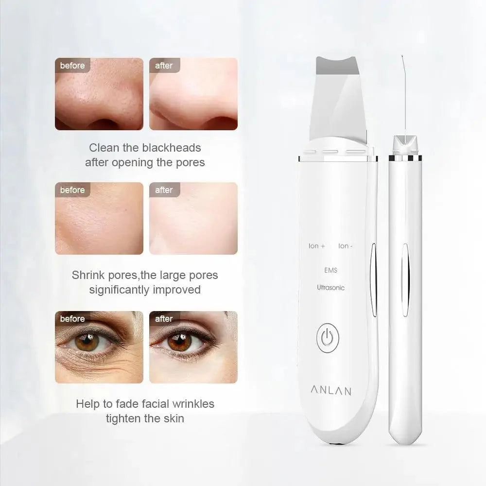 Pluma Exfoliadora Ultrasonica para Limpieza Profunda de la Piel