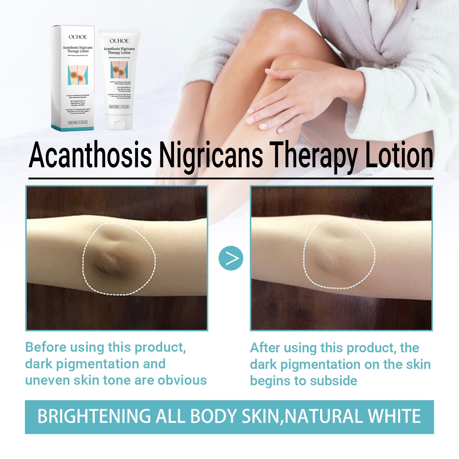 Acanthosis Nigricans Therapy Lotion, Skin Moisturizing Clean Black Dark Heavy Alar Knee Joint Repair Carry Bright Color Of Skin - Korvel