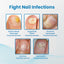 Anti-Paronychia Nail Repairing Gel, Repair Encased Rotten Nails Soft Nails Thickening Pain Relief Cleansing Care - Korvel
