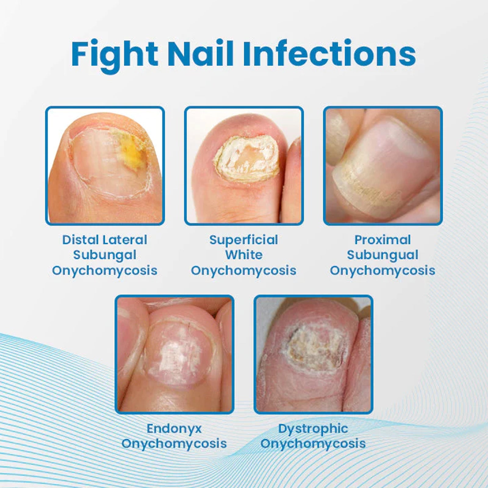 Anti-Paronychia Nail Repairing Gel, Repair Encased Rotten Nails Soft Nails Thickening Pain Relief Cleansing Care - Korvel
