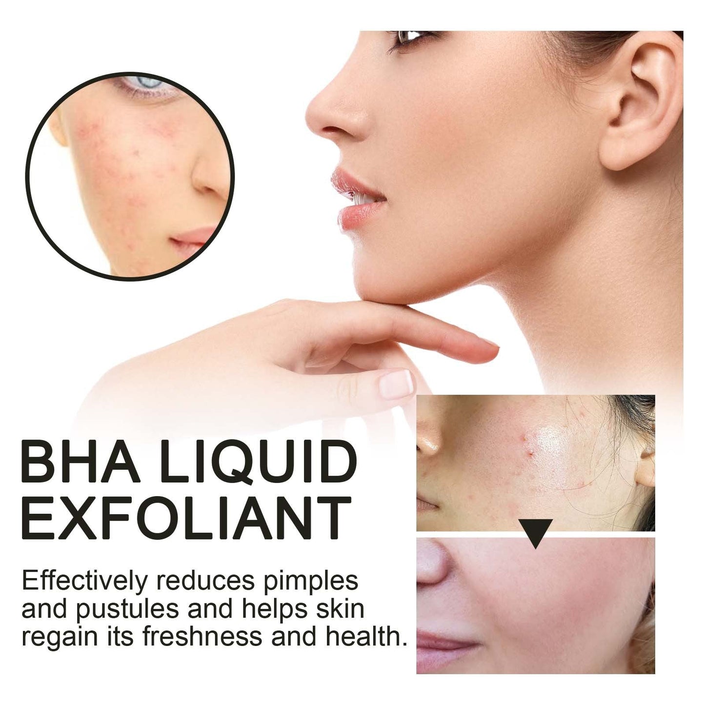 BHA Liquid Exfoliant, Lightening Acne Seal Pore-Tightening And Moisturizing Skin Essence - Korvel