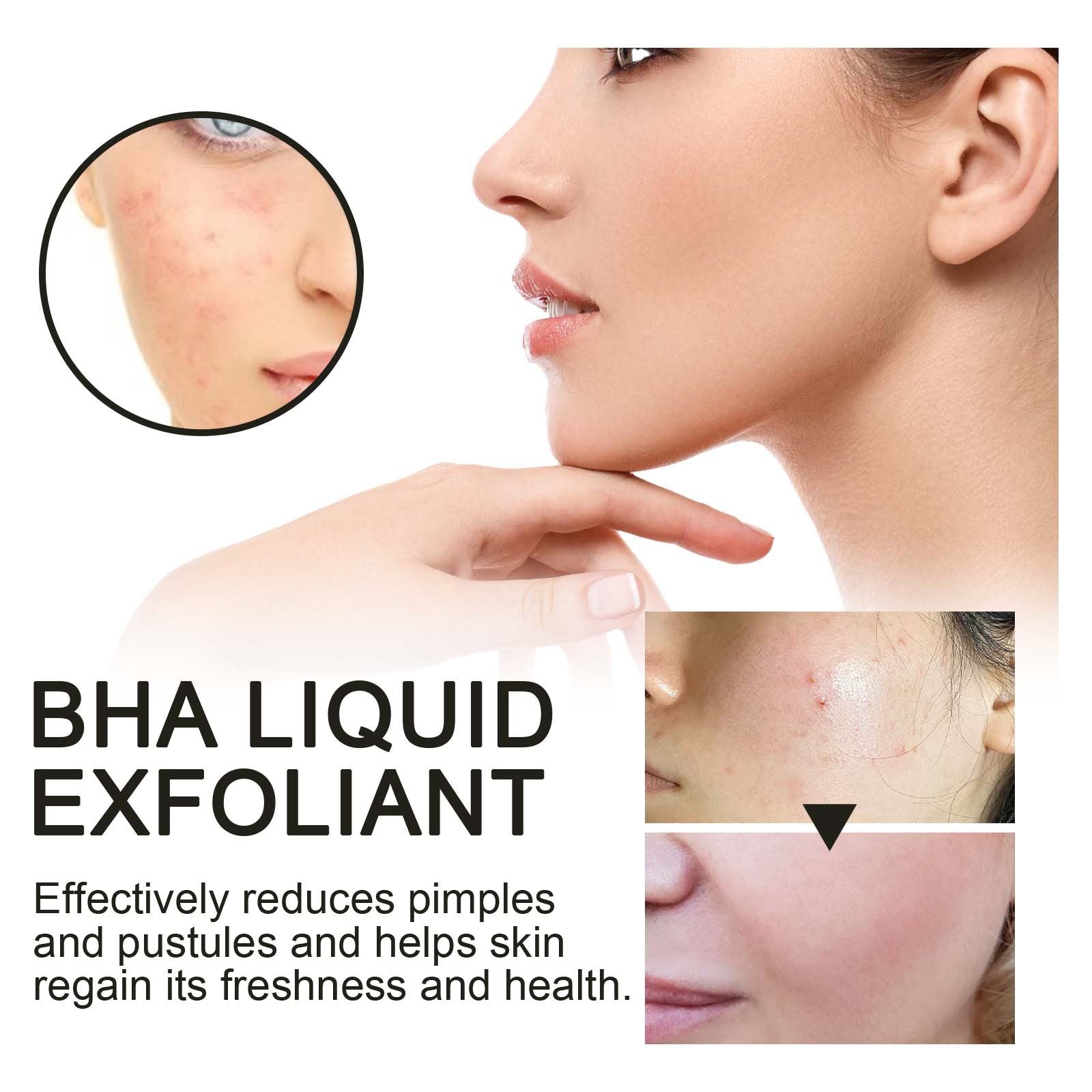 BHA Liquid Exfoliant, Lightening Acne Seal Pore-Tightening And Moisturizing Skin Essence - Korvel