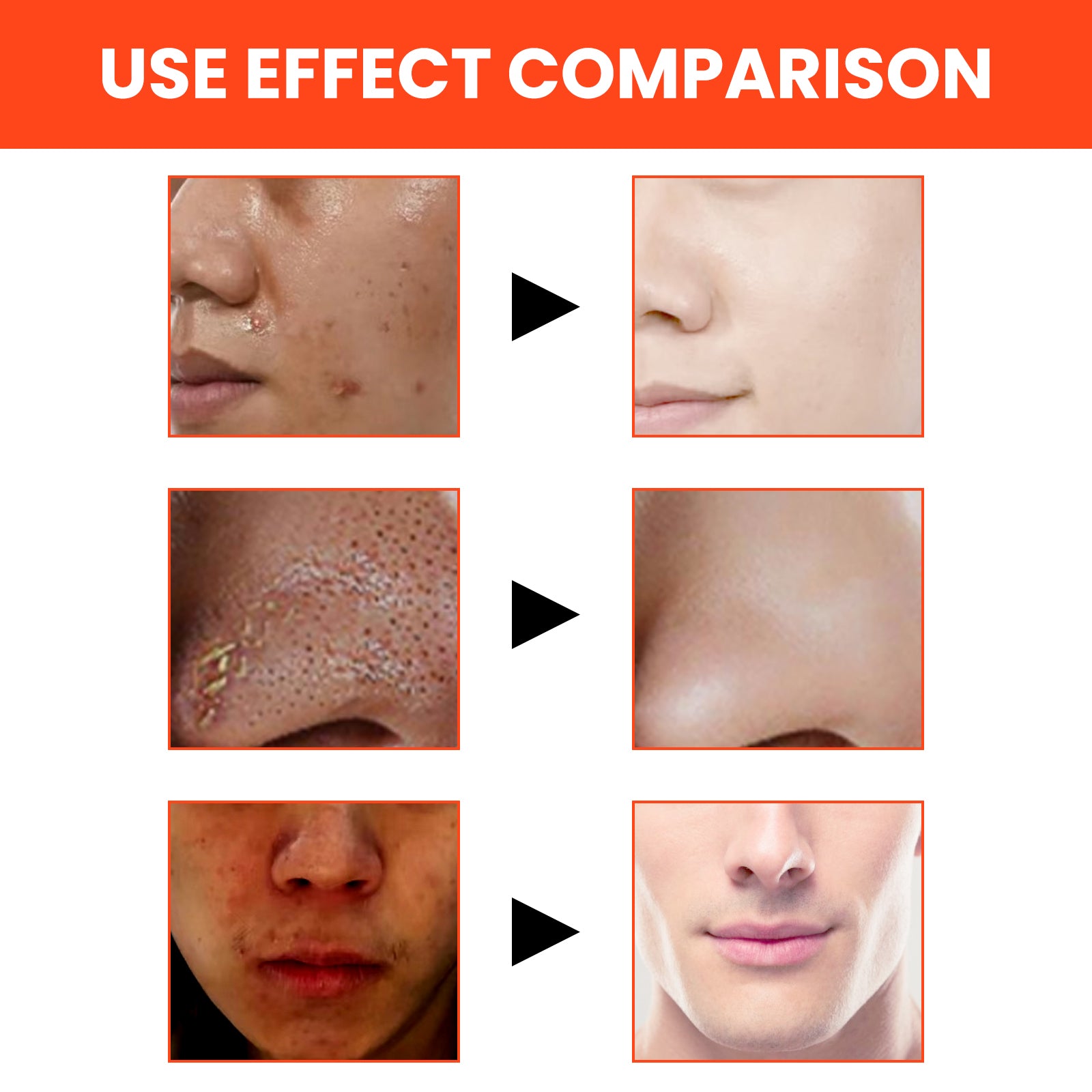 Men's Volcanic Face Wash, Acne Blackhead Face Deep Clean Pores And Oil Control - Korvel