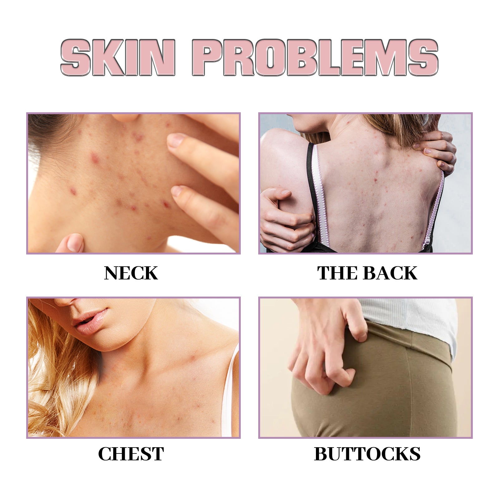 Acne Acne Ball, And Cleansing Skin Chest Back Acne Closing Skin Care - Korvel