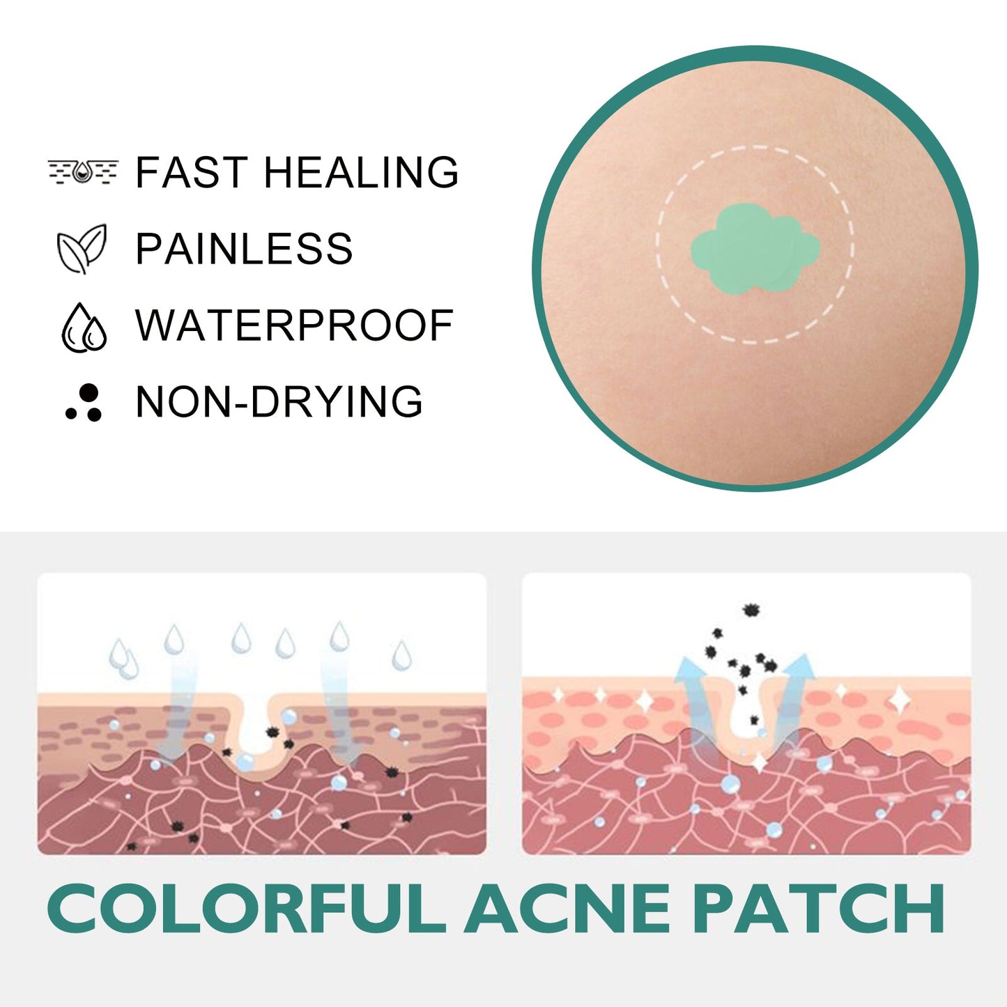Colorful Acne Patch, Repair Pit Acne Print Smooth Skin Lightening Spot Clear Acne Facial - Korvel