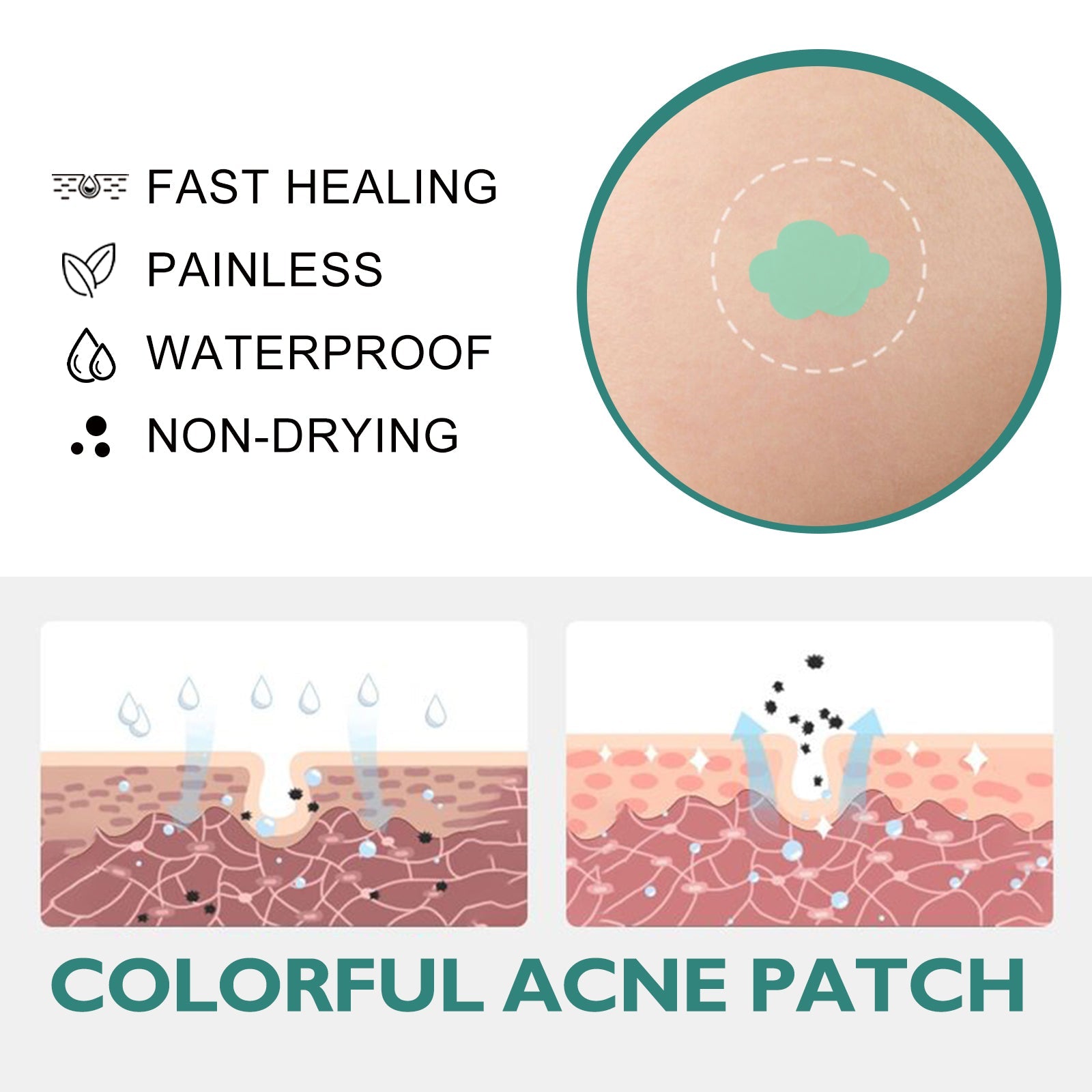 Colorful Acne Patch, Repair Pit Acne Print Smooth Skin Lightening Spot Clear Acne Facial - Korvel