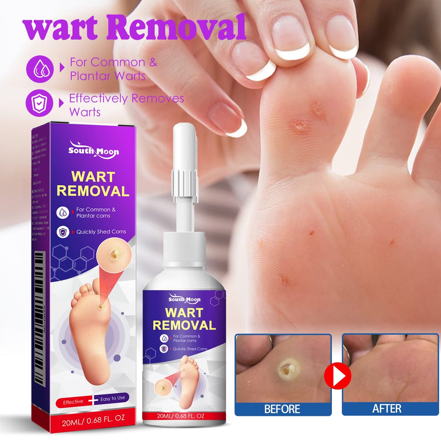 Remove Chicken Eye Lotion Extra Clear Remove Corns Skin Care Chicken Calluses Foot Pad Gram Warts - Korvel