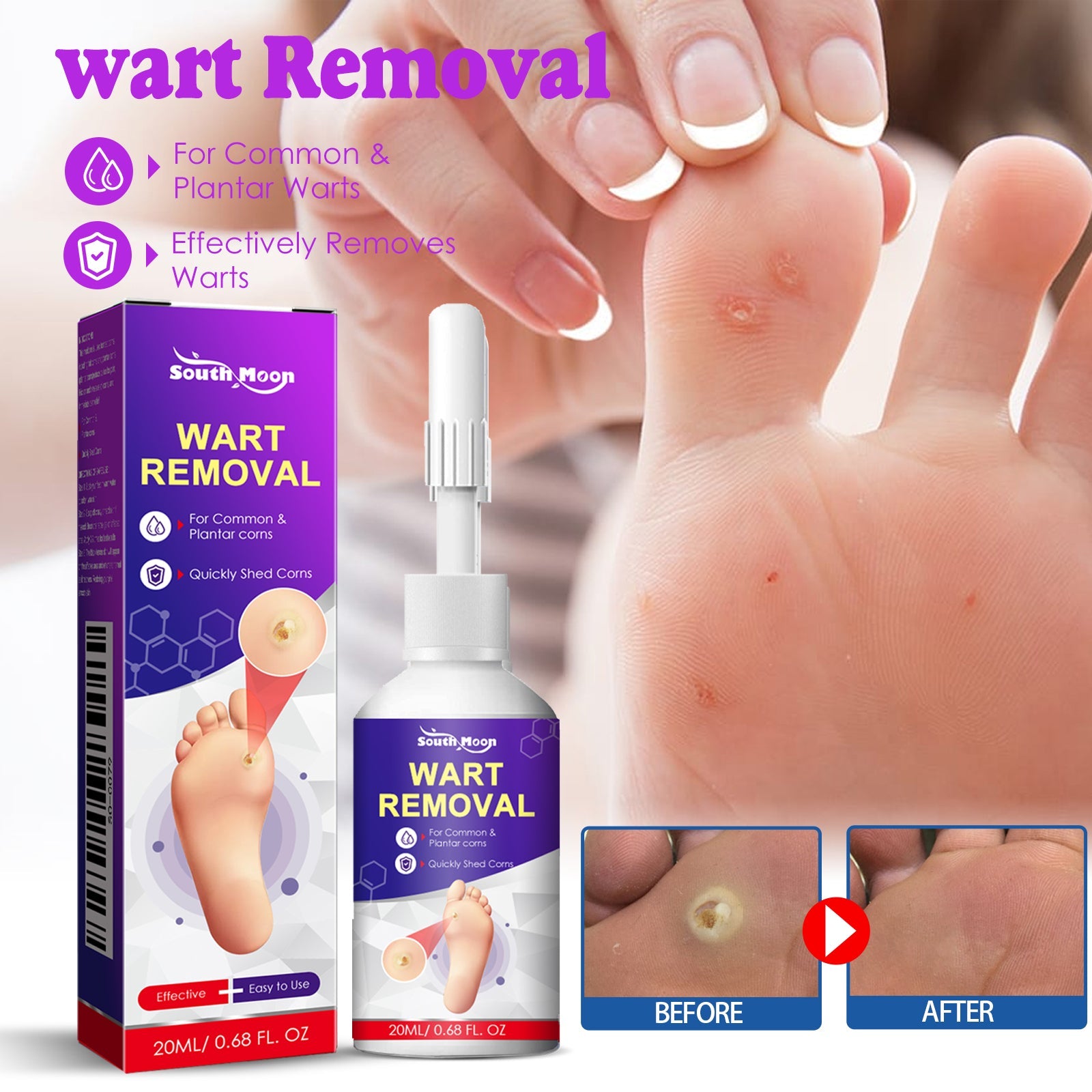 Remove Chicken Eye Lotion Extra Clear Remove Corns Skin Care Chicken Calluses Foot Pad Gram Warts - Korvel