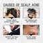 West & Month Anti-Shedding Hair Spray, Improve The Hairline Hair Hair Nutrition Moisture Hair Roots - Korvel