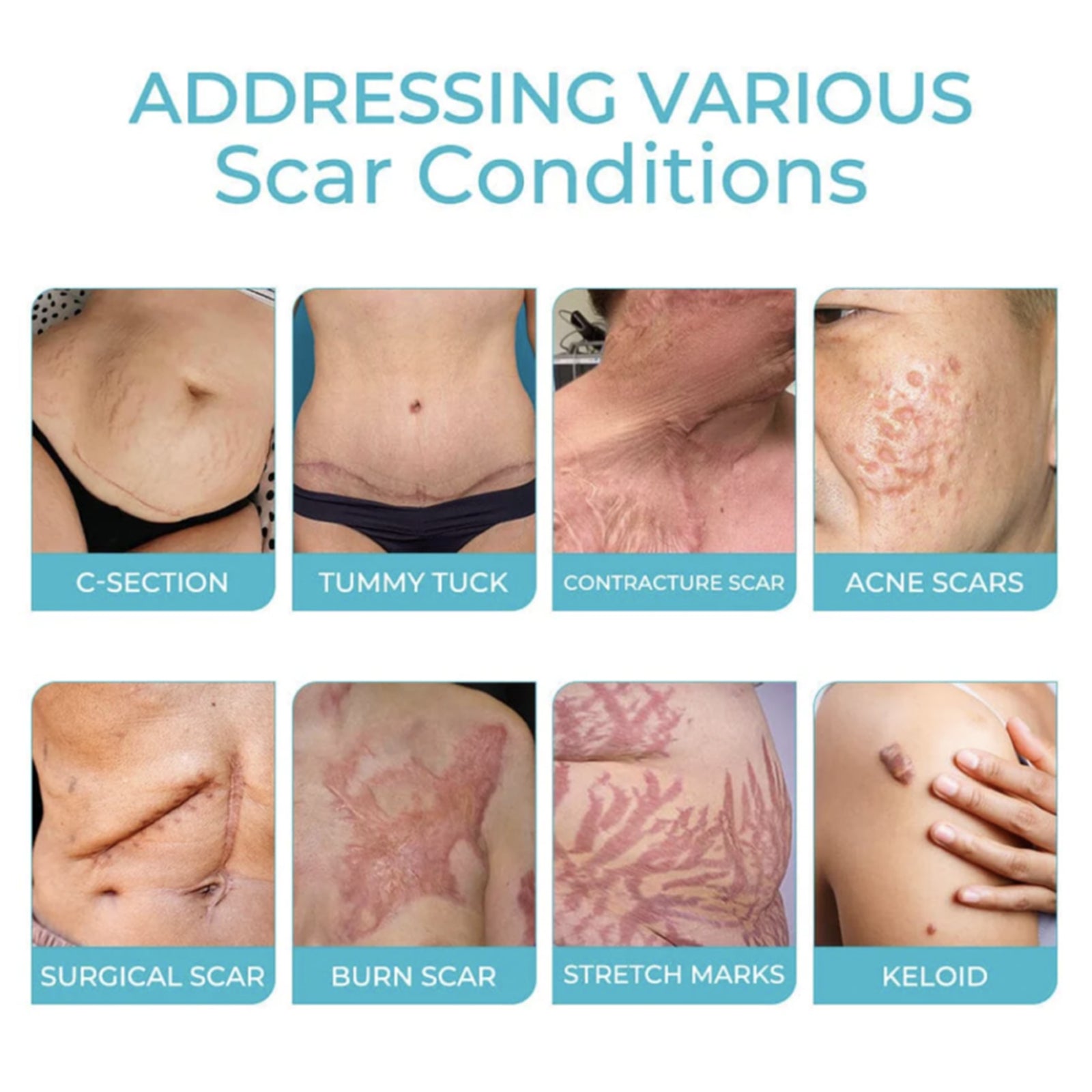 Scarfree Advanced Skin Spray, Body Skin Care Reduces Post-Natal Scars And Smooths Skin - Korvel