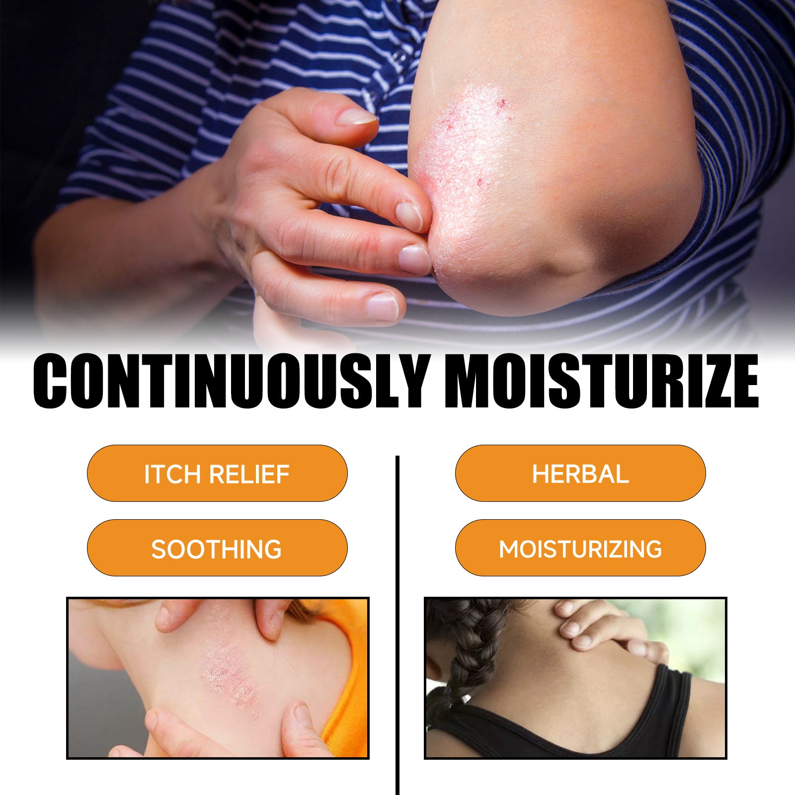 Bee Venom Psoriasis Care Spray, Soothing Skin Irritation Repair Moisturizing And Tender Skin Care Spray - Korvel
