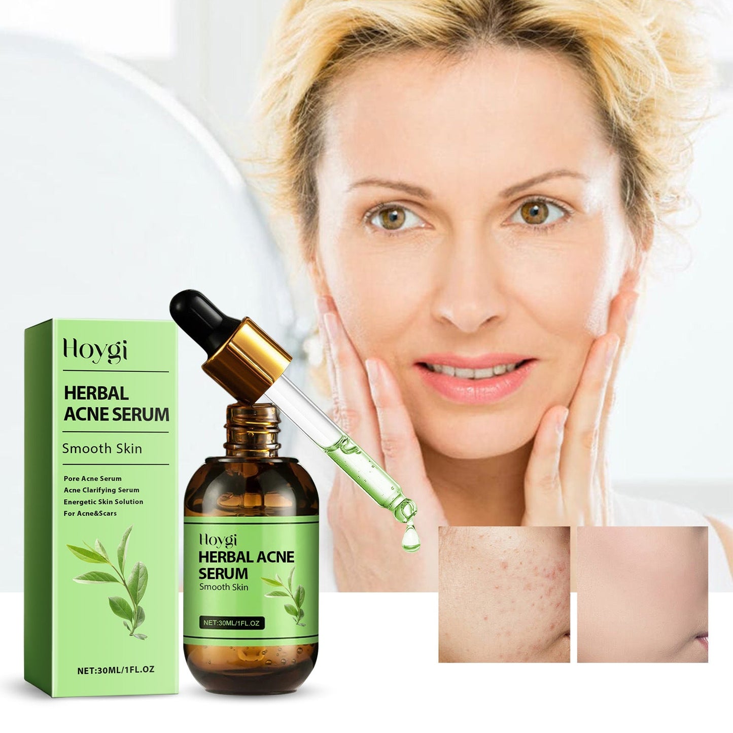 Premium Herbal Acne Serum for Clear Skin