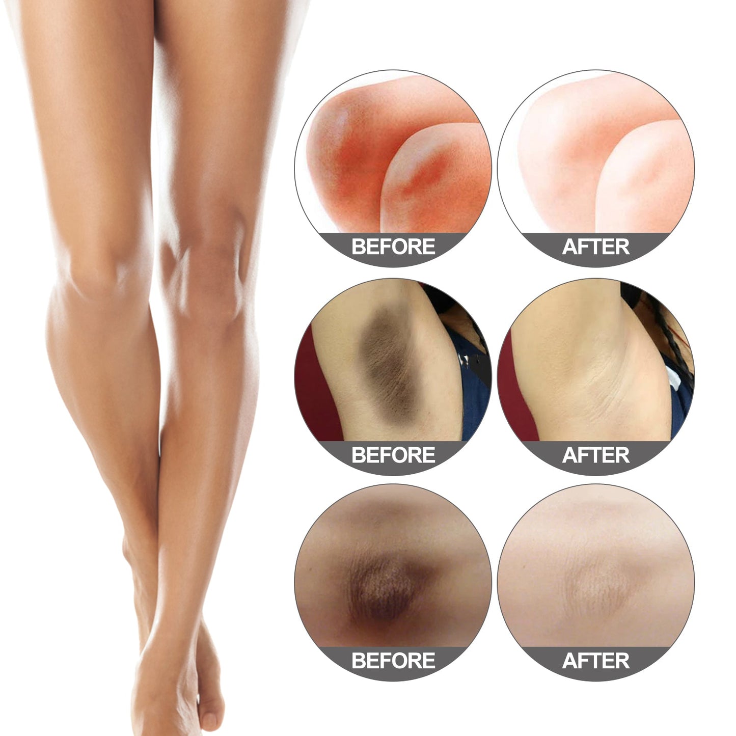 Beauty Care, Moisturizing And Brightening For Elbow And Knee Joints, Black Exfoliating, Nourishing And Whitening - Korvel