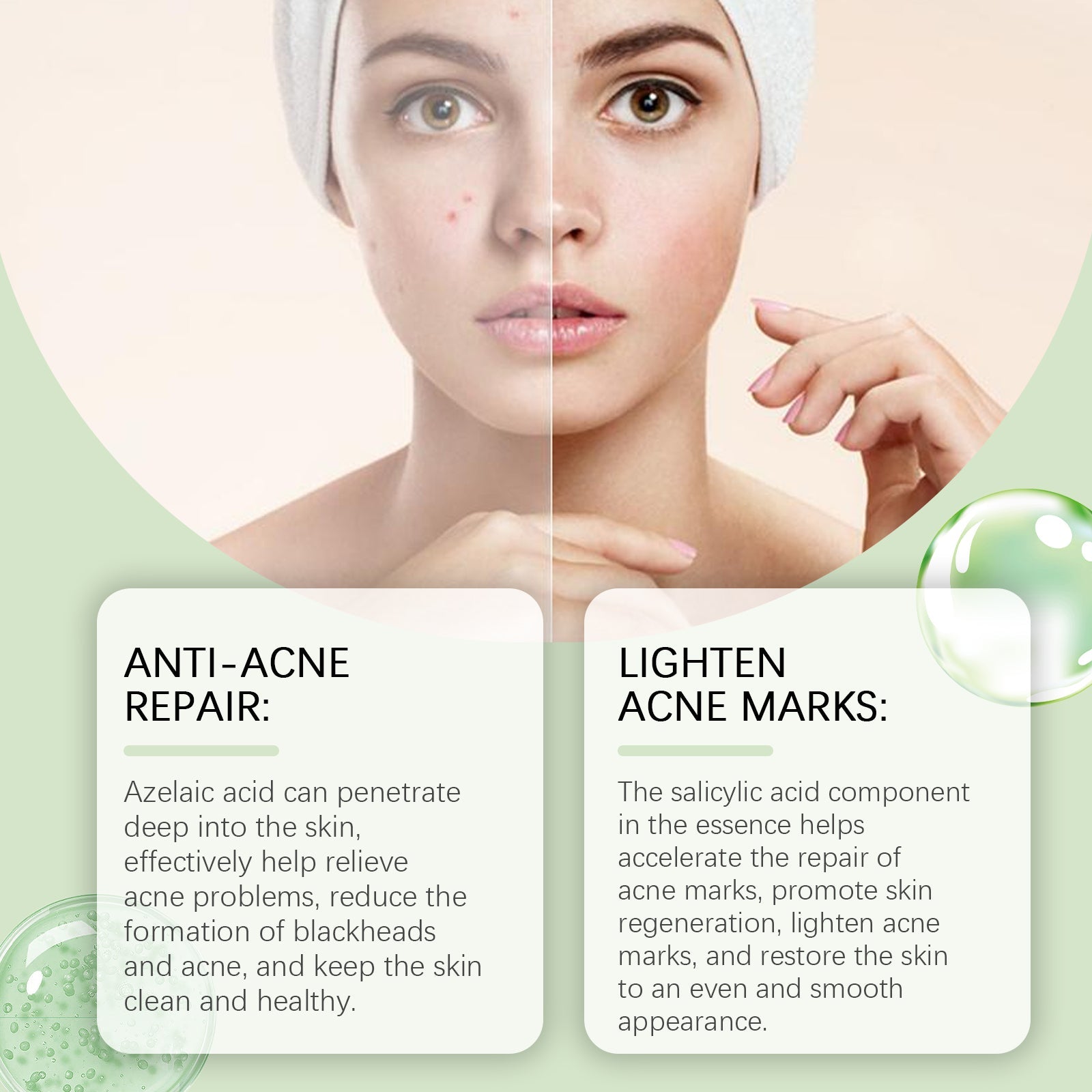 Azelaic Acid Facial Essence Moisturizes And Improves The Skin For Blackheads And Acne - Korvel