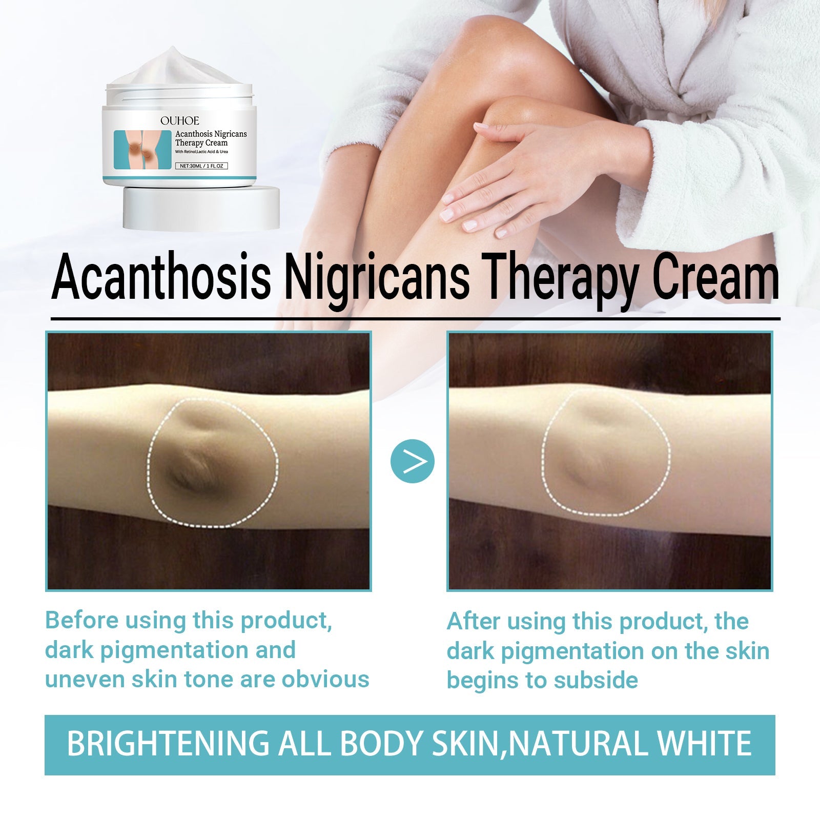 Acanthosis Nigricans Therapy Cream, Repair Dull Skin Lightening Joint Black Moisturizing Whitening Skin Care Cream - Korvel