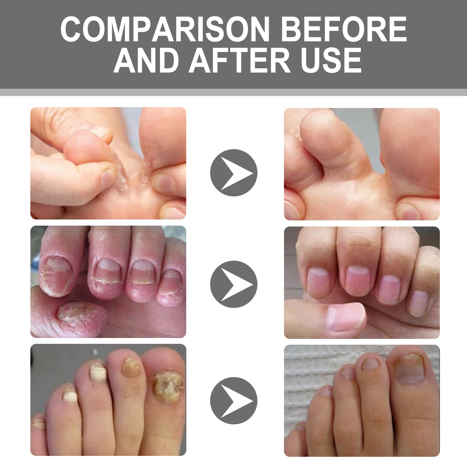 Nail Care Cream, Light Armor Repair Bad Ingrown Nail Nails Brothers Nail Thickening A Ditch Nursing - Korvel