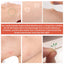 Youbuy Invisible Acne Patch Concealer - 72 Patches