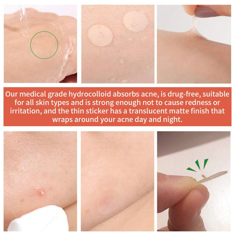 Youbuy Invisible Acne Patch Concealer - 72 Patches