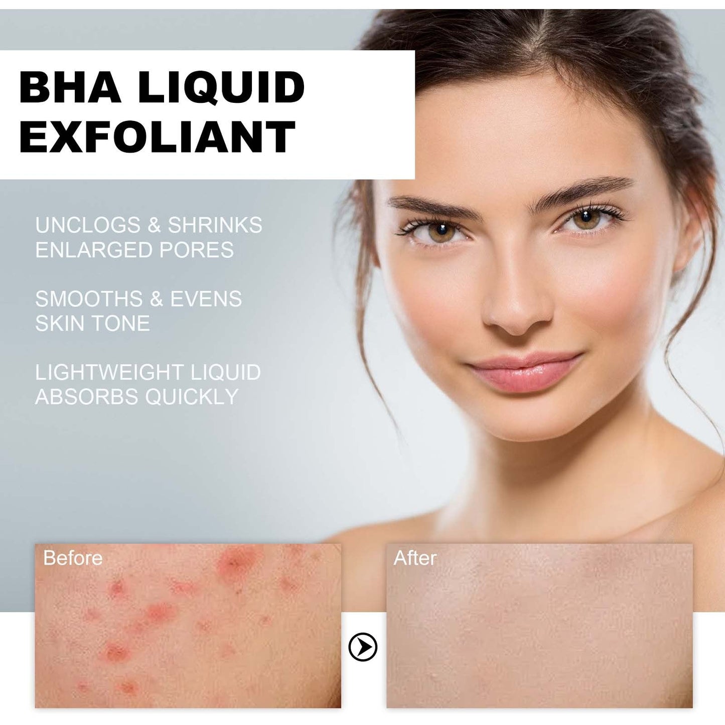 BHA Liquid Exfoliant, Lightening Acne Seal Pore-Tightening And Moisturizing Skin Essence - Korvel