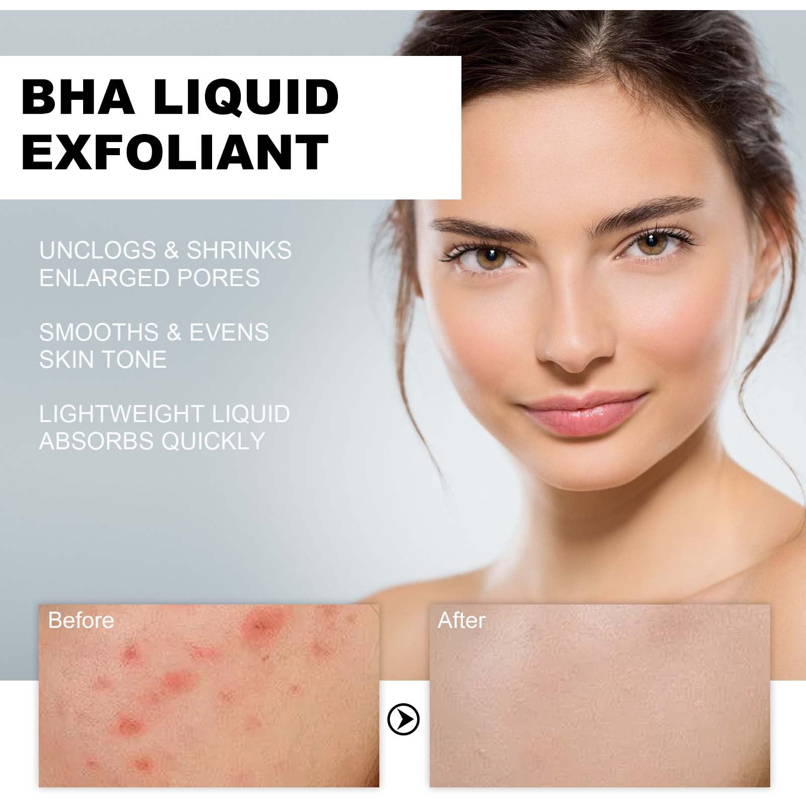 BHA Liquid Exfoliant, Lightening Acne Seal Pore-Tightening And Moisturizing Skin Essence - Korvel