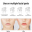 Invisible Lifting Patch for a Defined V-Face