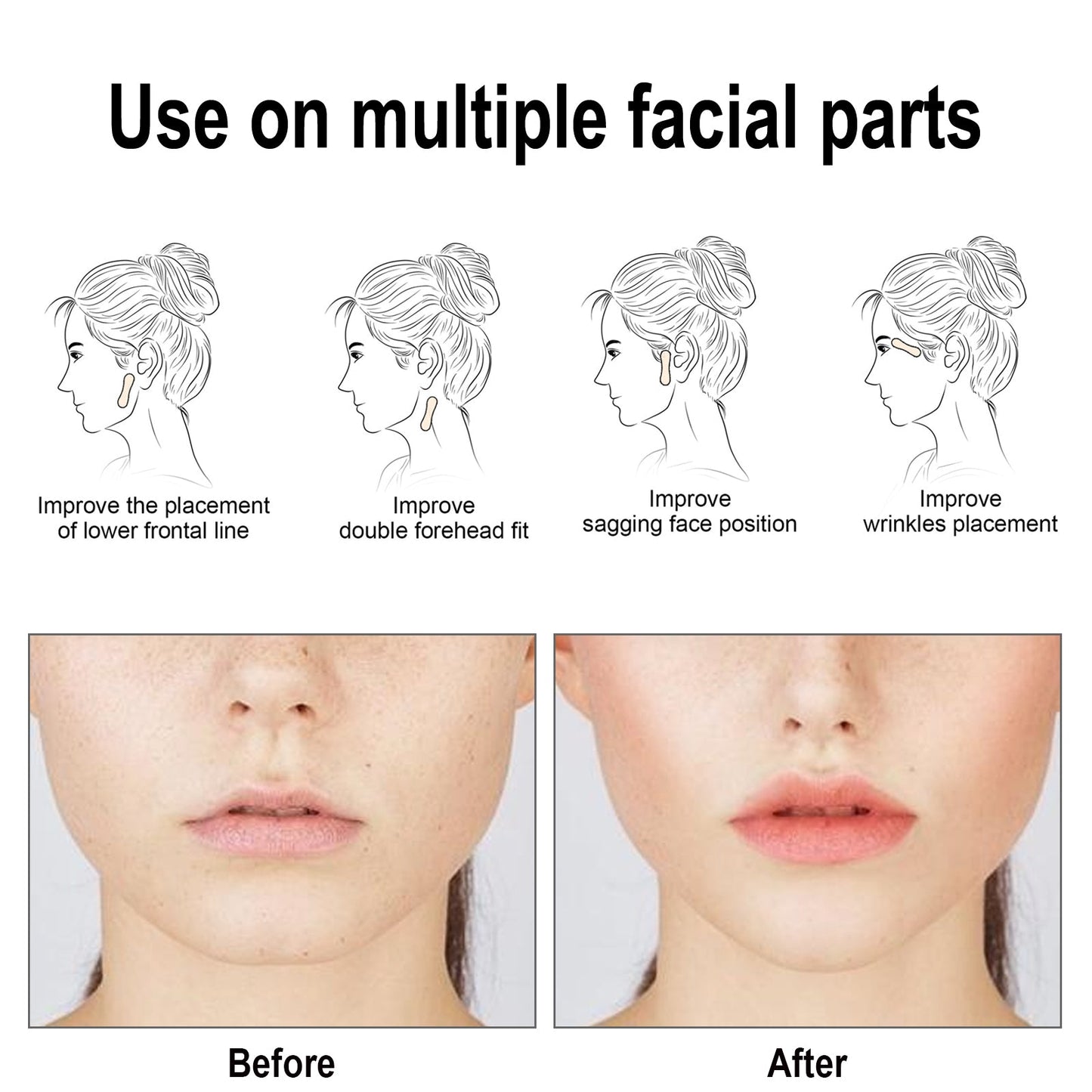 Invisible Lifting Patch for a Defined V-Face