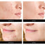 Youbuy Invisible Acne Patch Concealer - 72 Patches