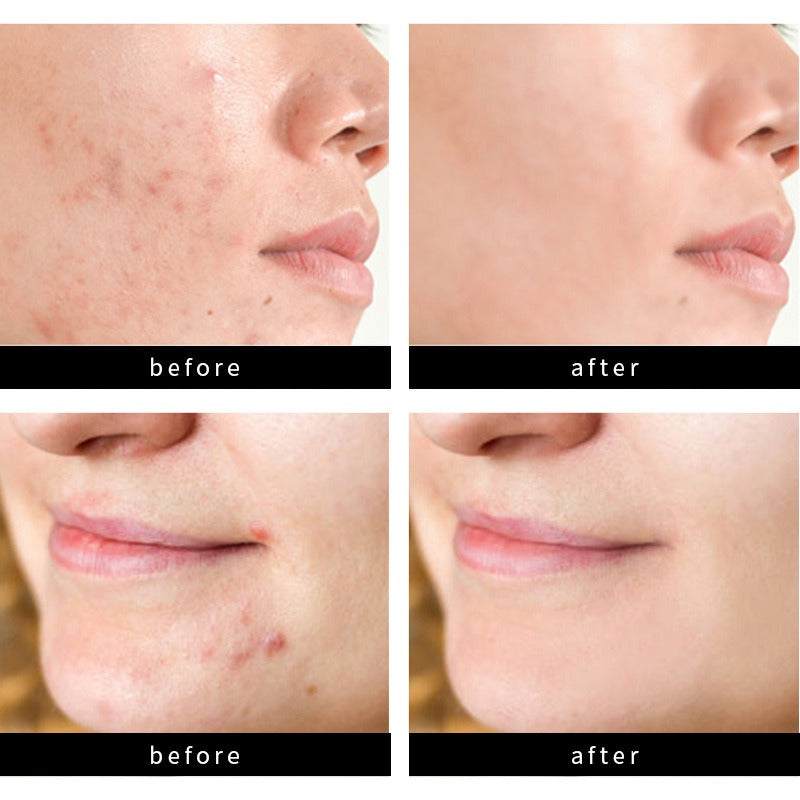 Youbuy Invisible Acne Patch Concealer - 72 Patches