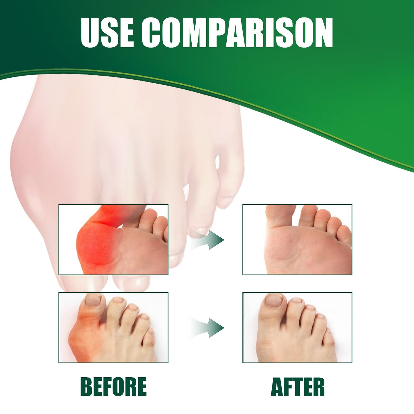 Bunion Relief Patch Thumb Valgus Bigfoot Bunion Valgus Double Toe Foot Care Patch - Korvel