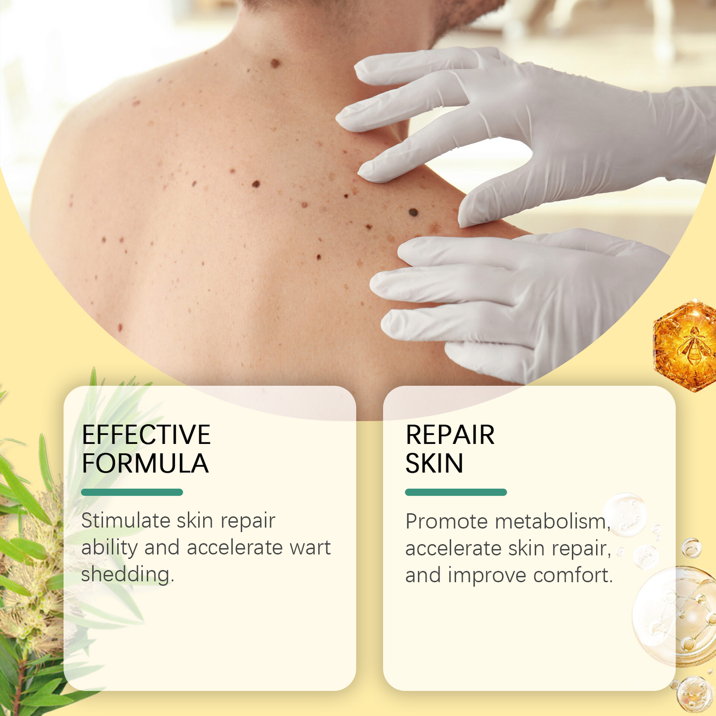 Bee Venom Wart & Mole Removal Spray, Gentle Cleansing Skin Moisturizing Moisturizing Smooth Skin Care - Korvel
