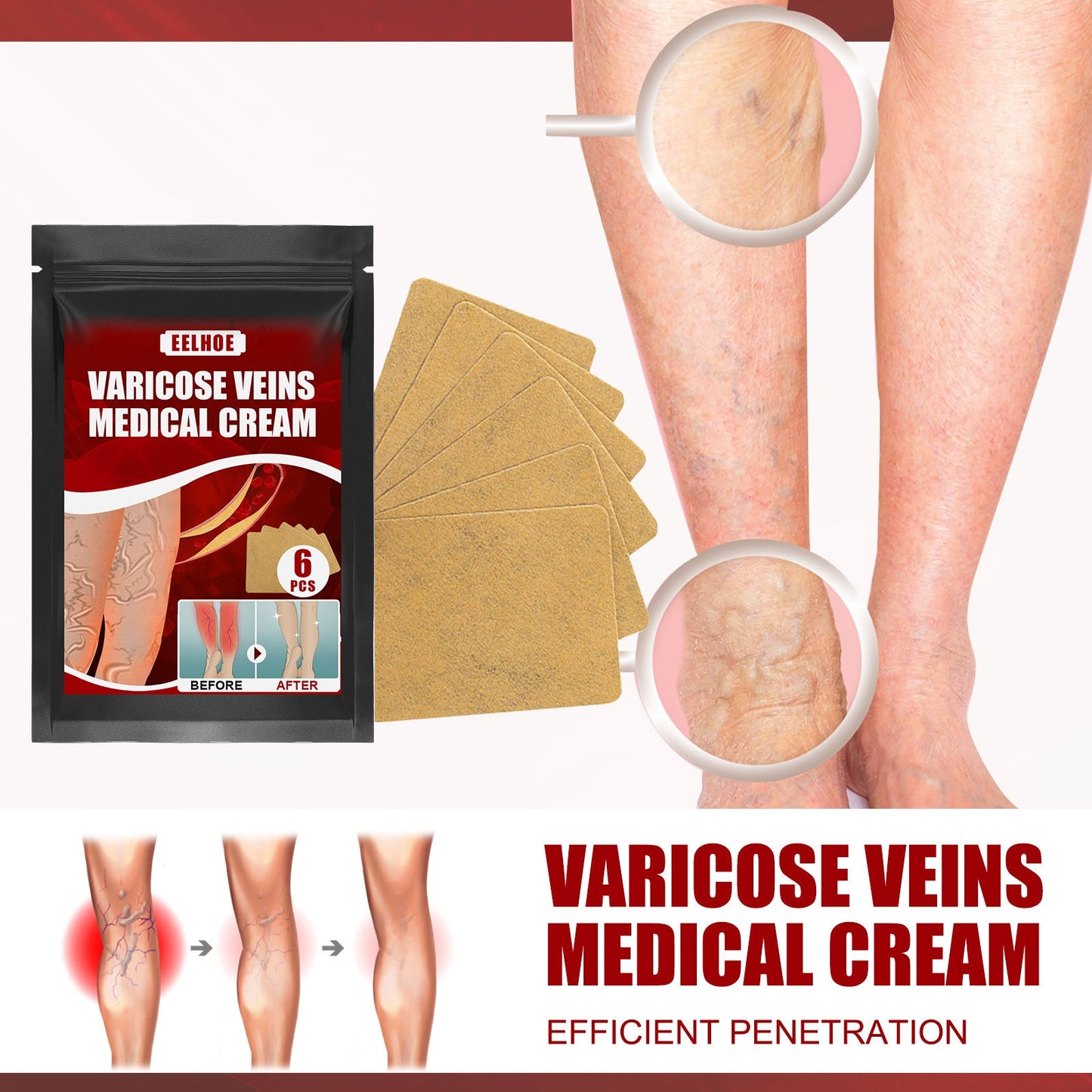 Aricose Veins Medical Cream, Relieve Leg Swelling Earthworm Leg Vein Massage To Relieve Pain - Korvel