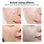 BREYLEE Acne Treatment Face Serum Mask Anti Acne Pimple Scar Remover Moisturizing Whitening Skin Care Facial Essence Cream 17ml - Korvel