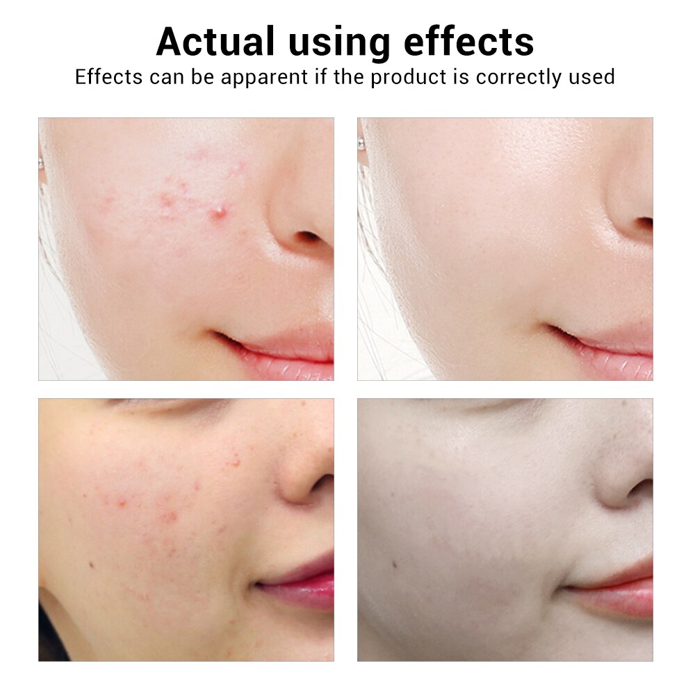 BREYLEE Acne Treatment Face Serum Mask Anti Acne Pimple Scar Remover Moisturizing Whitening Skin Care Facial Essence Cream 17ml - Korvel