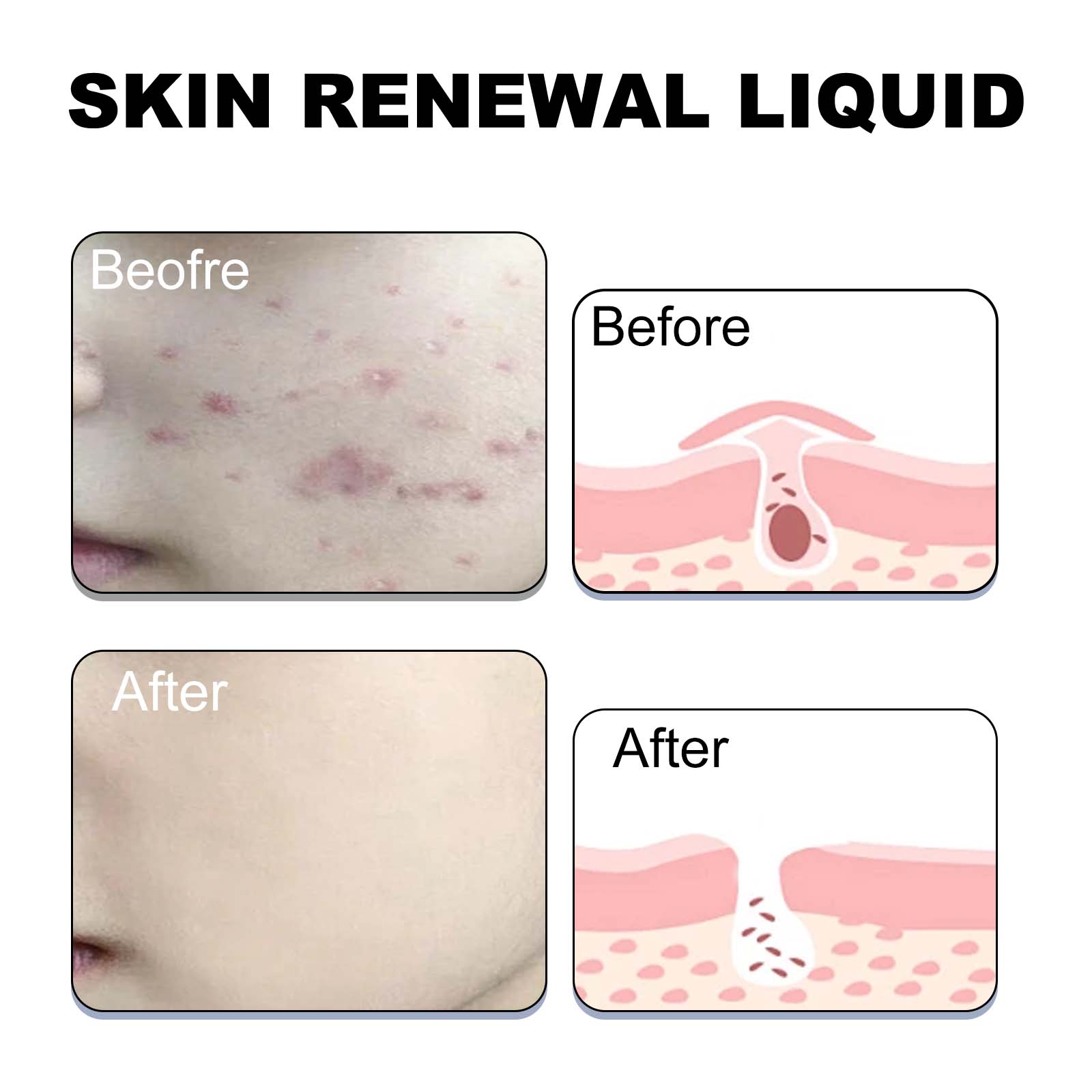 Skin Renewal Liquid, Reduce Acne Print Repair Acne Muscle Mild Clear Acne Hydrating Essence - Korvel