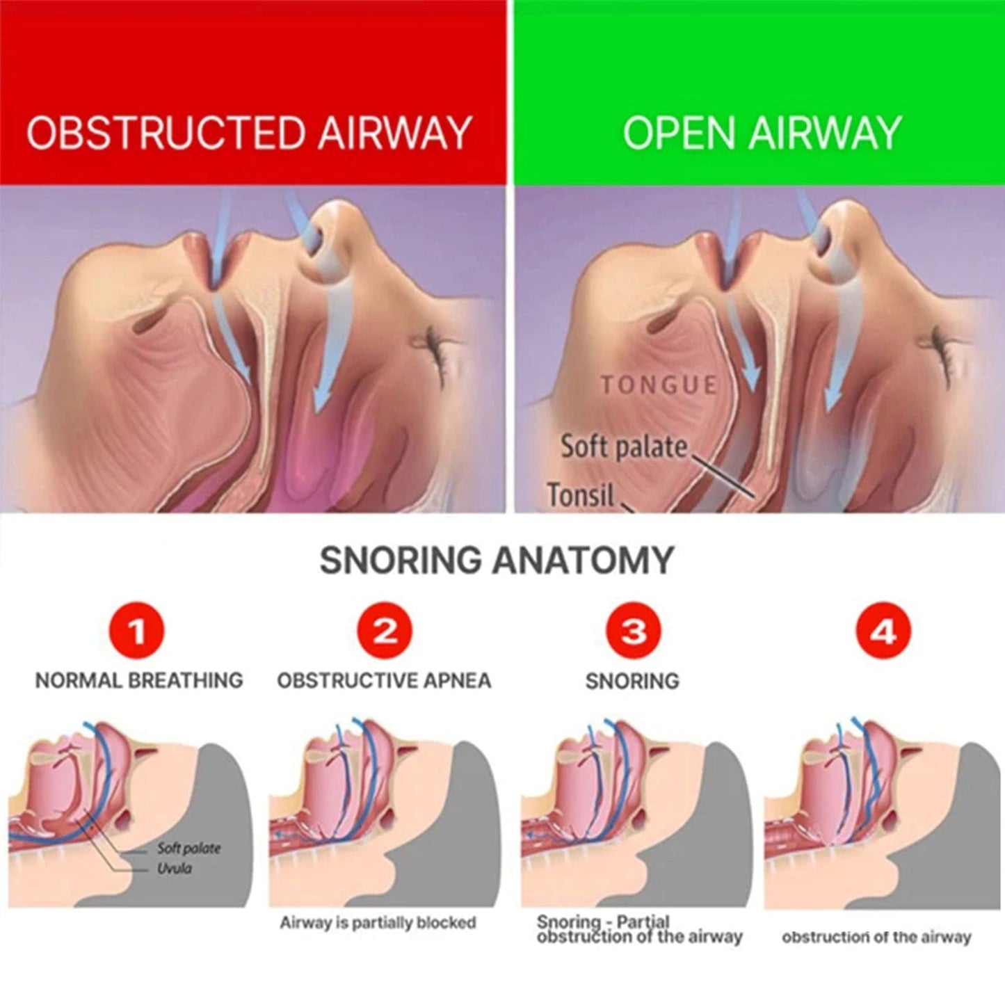 Anti-Snoring Braces Anti-Snoring, Anti-Grinding, Anti-Breathing Mouth Guard Anti-Snoring Dental Support Protective Braces - Korvel