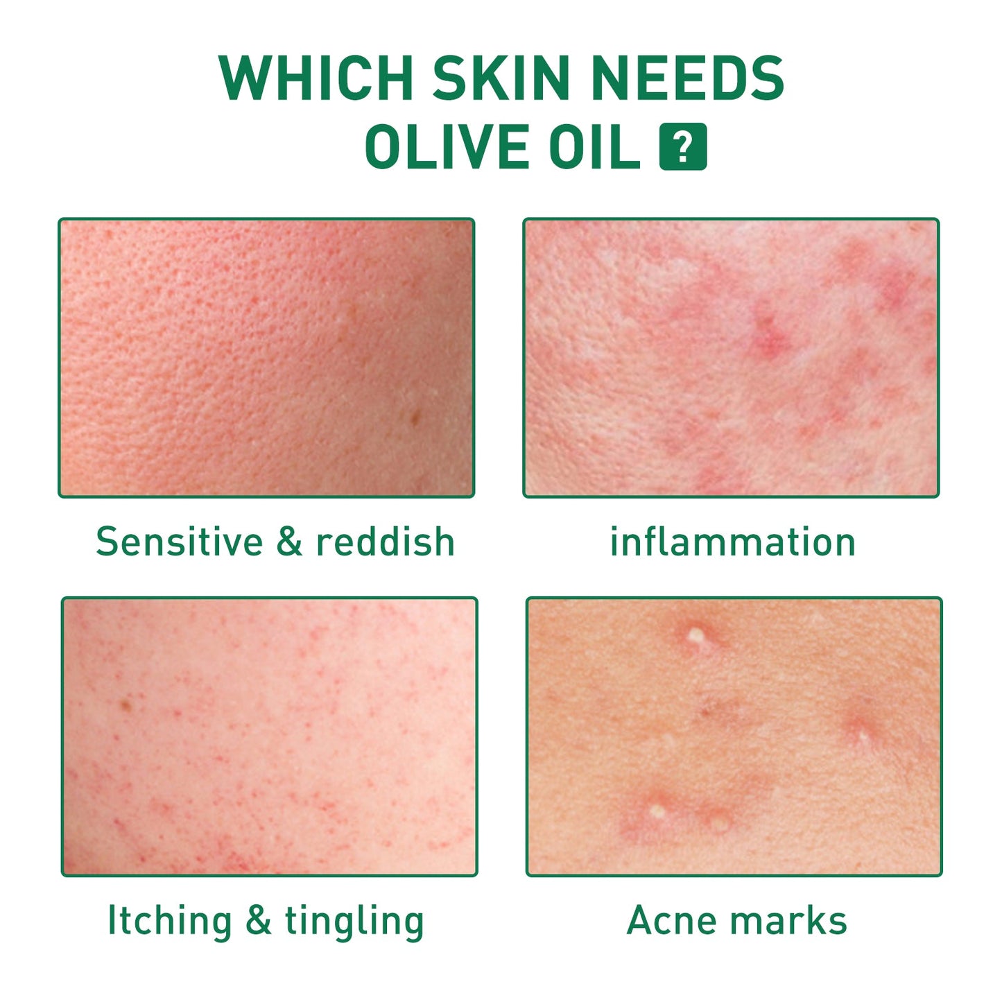 Tea Tree Oil Acne Serum, Remove Acne, Clear Acne, Repair Skin, Lighten Acne Printing Face Essence - Korvel