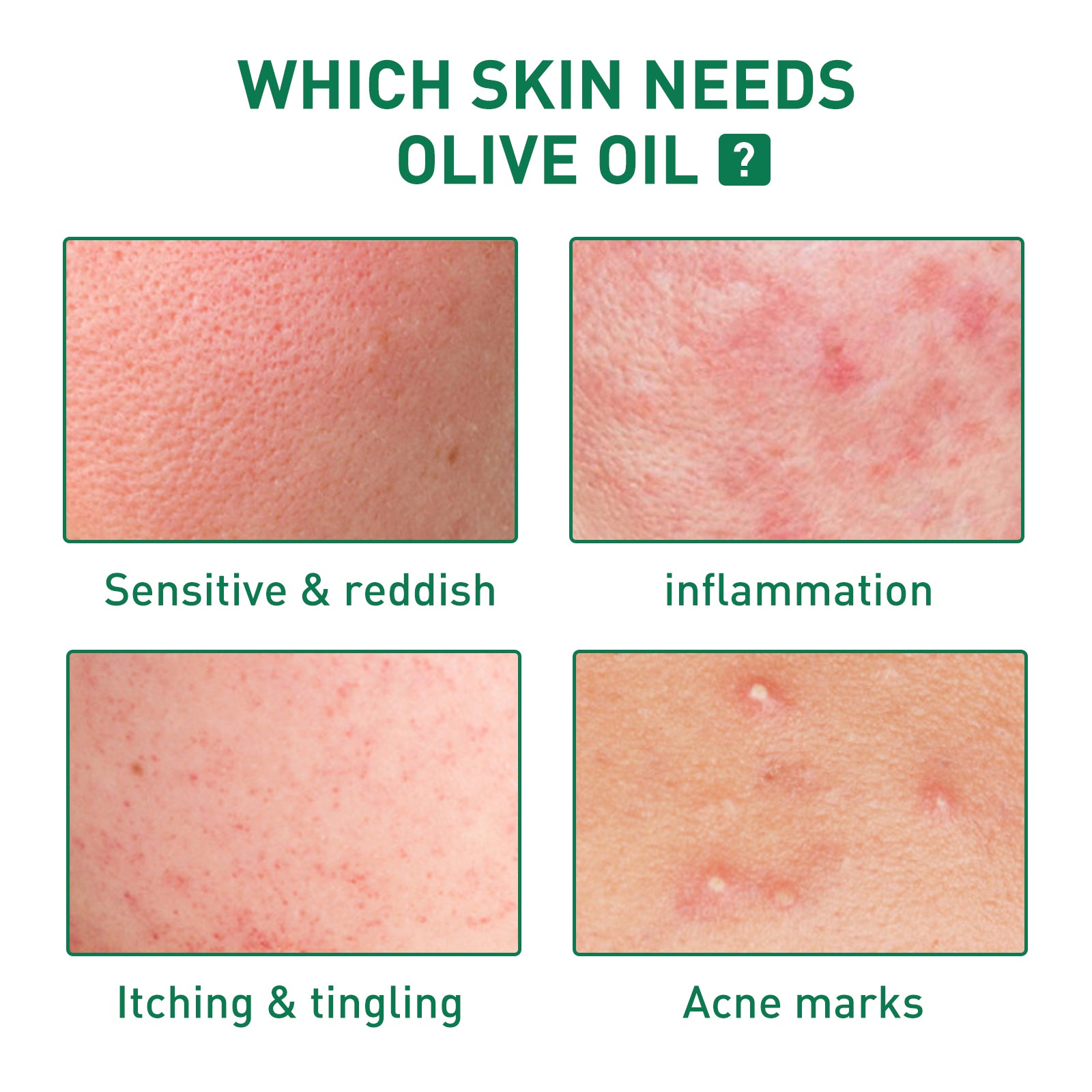 Tea Tree Oil Acne Serum, Remove Acne, Clear Acne, Repair Skin, Lighten Acne Printing Face Essence - Korvel