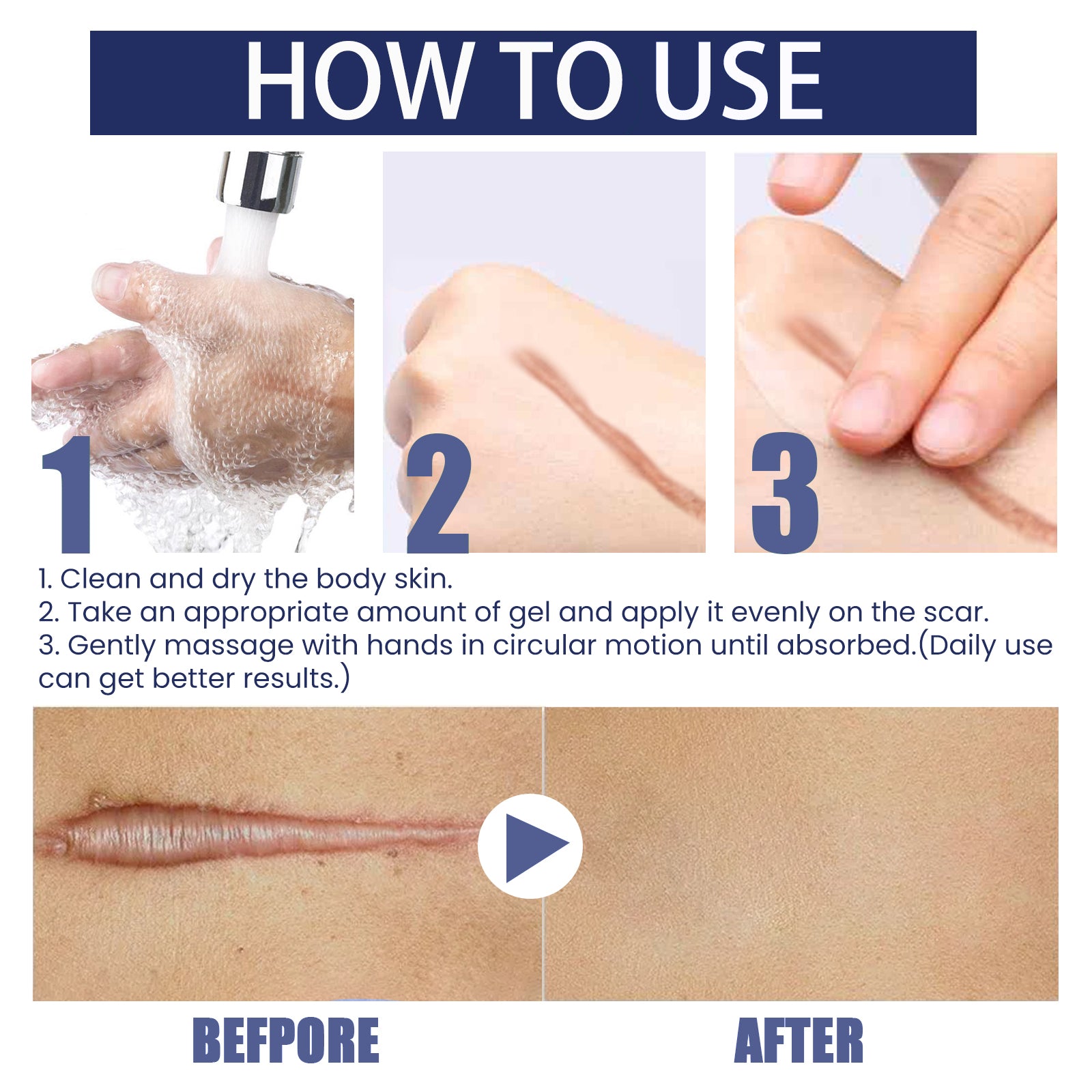 Scar Gel, Fade Skin Scar Pregnancy Surgery Scar Moisturizing Skin Care Gel - Korvel