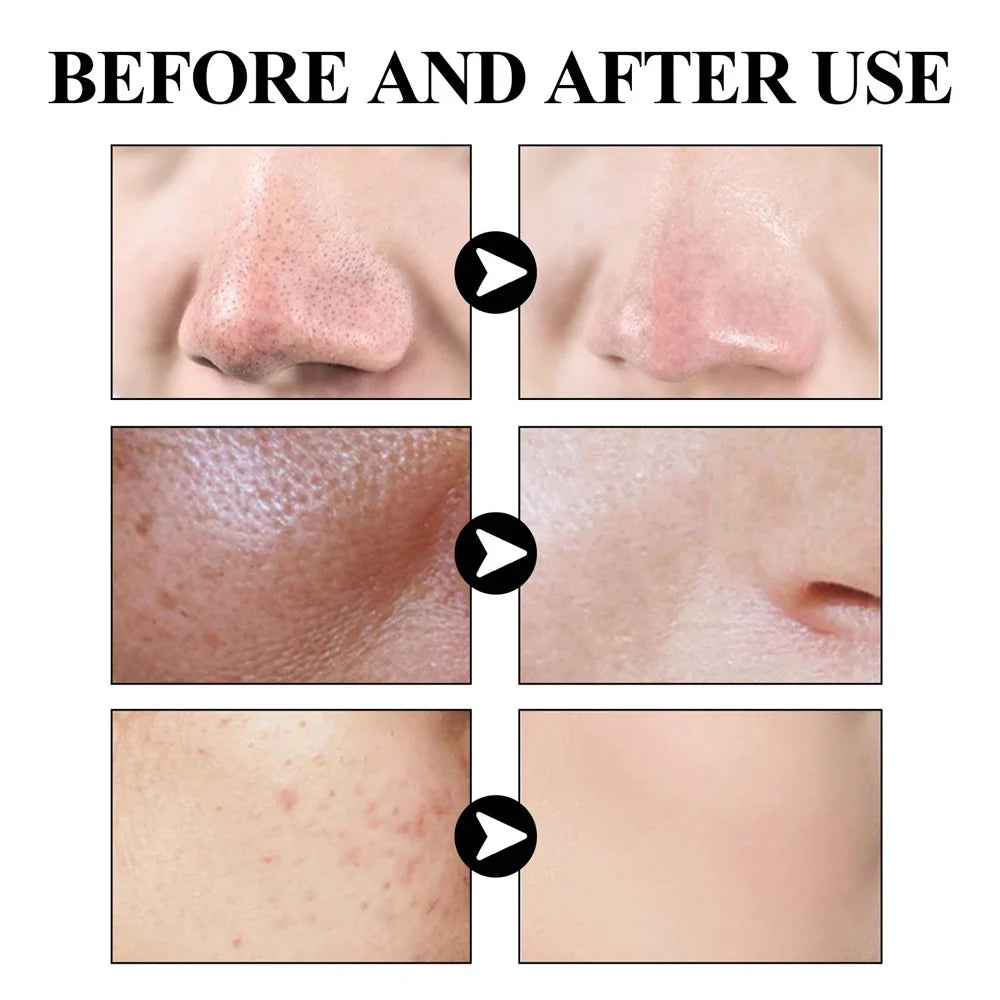 West & Month Blackhead Remove Solid Mud Film Refreshing Skin Cleaning Face Mask Moisturize Control Oil Shrink Pores Skin Care - Korvel