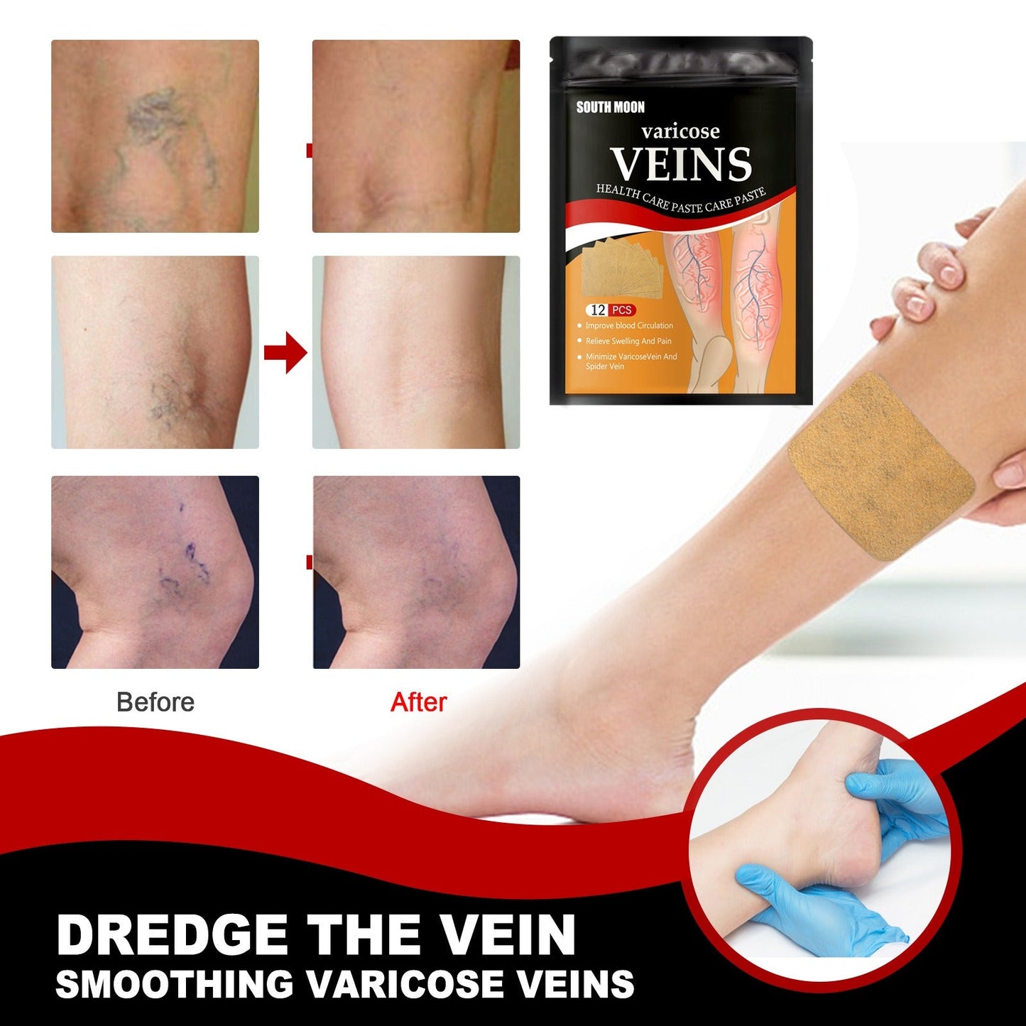 Venous health patch relieves varicose blood vessel blockage and protrusions in the feet. Cold compress venous health patch - Korvel