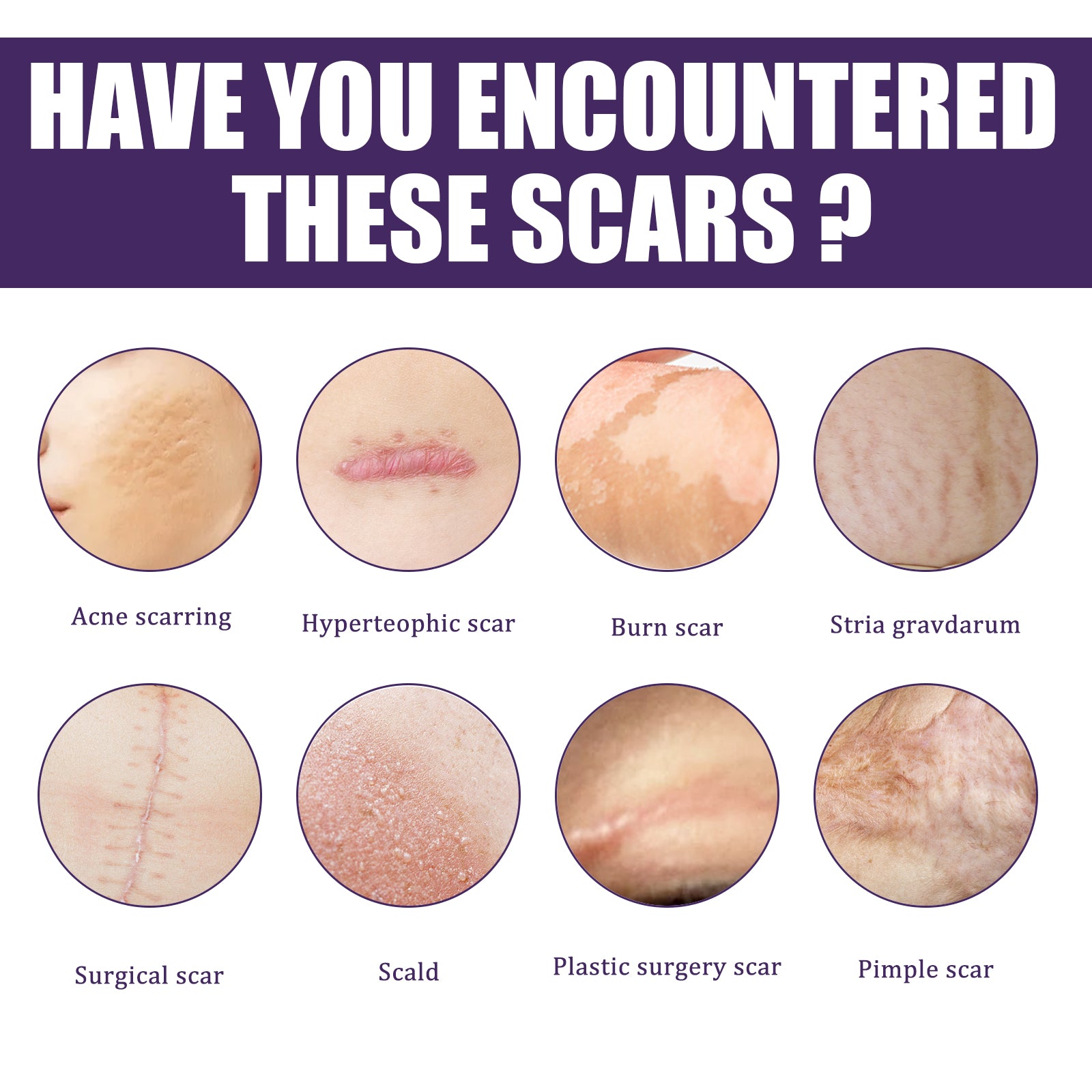 Silicone Scar Patch, Reduces Stretch Marks And Hyperplasia Of Caesarean Section Scars Silicone Patch - Korvel