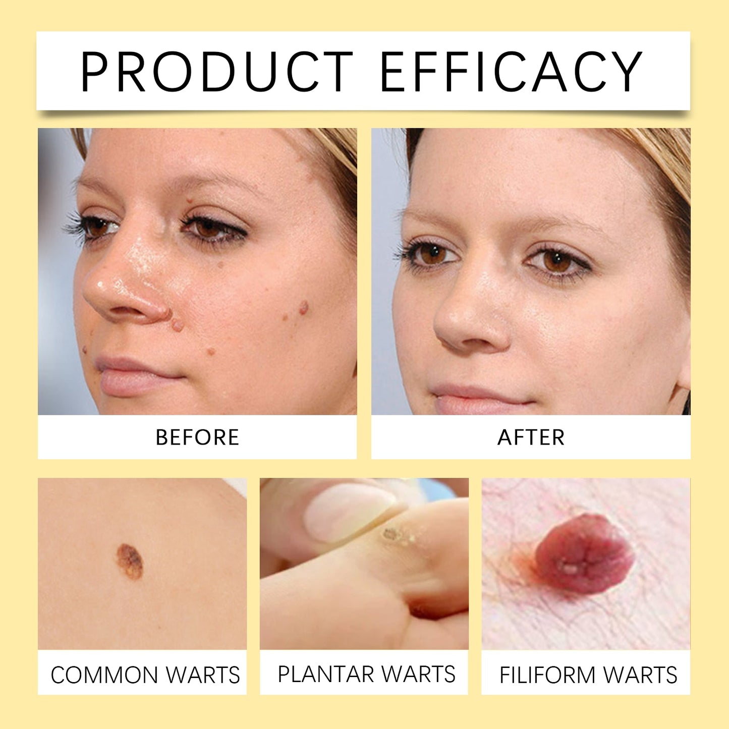 Bee Venom Wart & Mole Removal Spray, Gentle Cleansing Skin Moisturizing Moisturizing Smooth Skin Care - Korvel