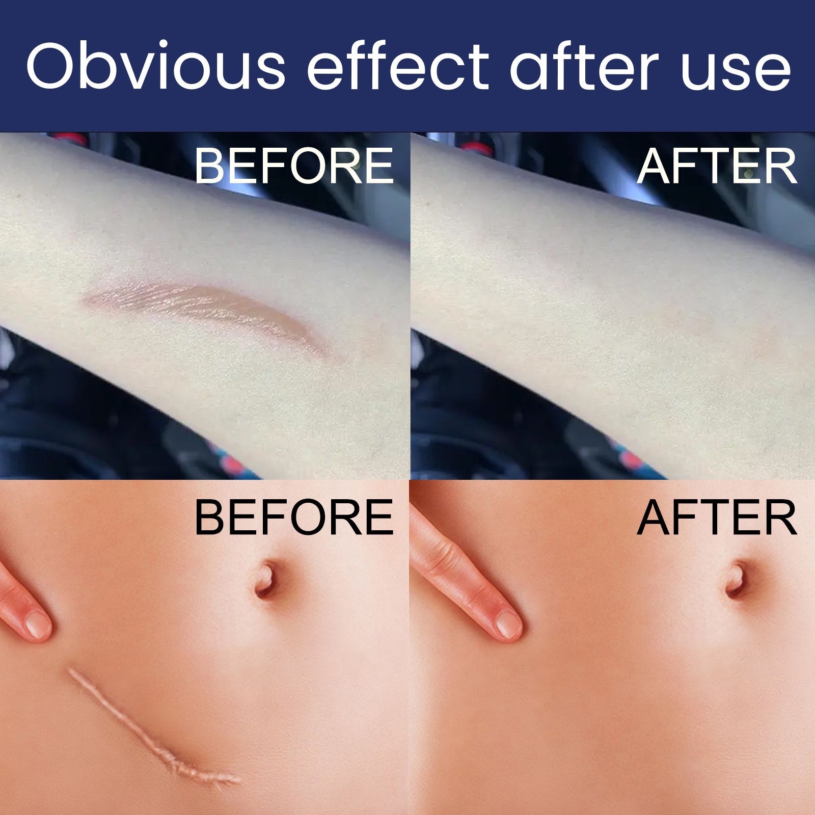 Scar Gel, Fade Skin Scar Pregnancy Surgery Scar Moisturizing Skin Care Gel - Korvel