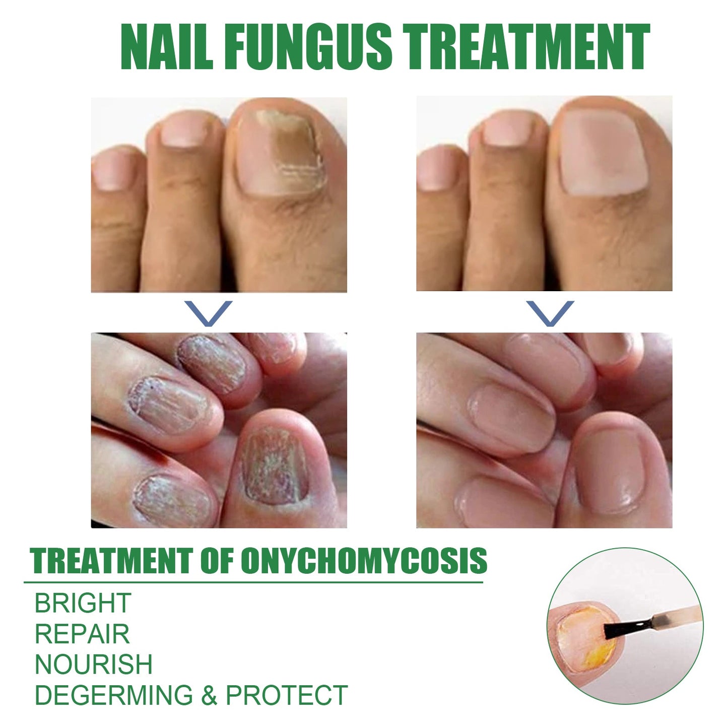 Solution de réparation des ongles avec essence d'huile d'arbre à thé