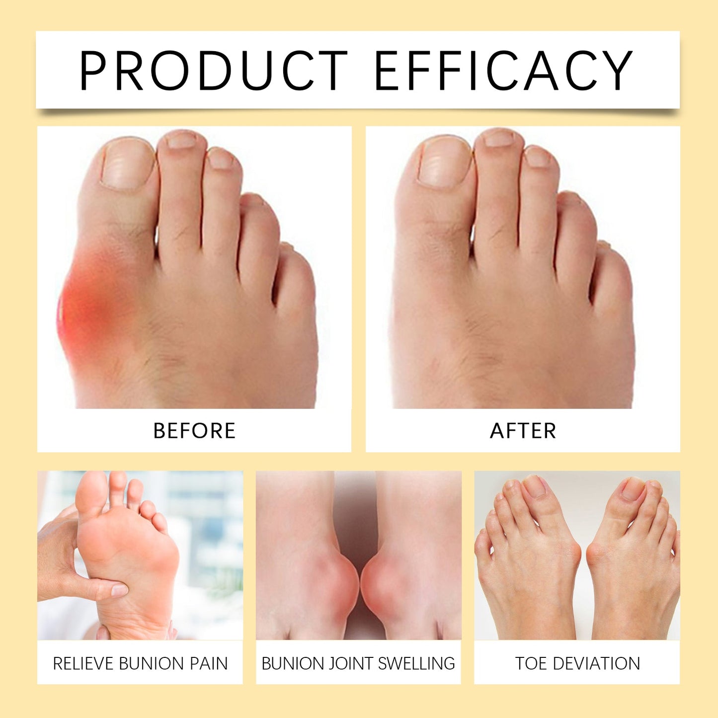 Bee Venom Care Cream, Bee Venom Care Cream To Relieve Inflammation, Pain Swelling Can Improve Joint Health Bunions Adjuvant Therapy - Korvel