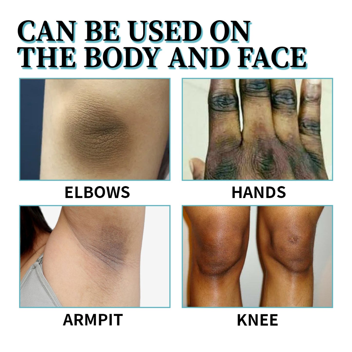 Acanthosis Nigricans Therapy Lotion, Skin Moisturizing Clean Black Dark Heavy Alar Knee Joint Repair Carry Bright Color Of Skin - Korvel