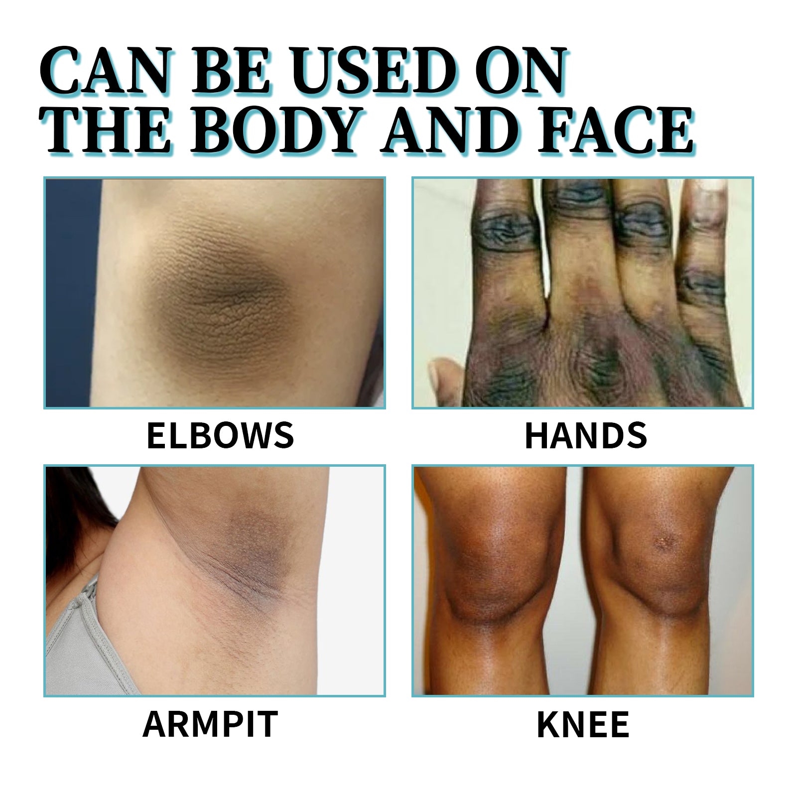 Acanthosis Nigricans Therapy Lotion, Skin Moisturizing Clean Black Dark Heavy Alar Knee Joint Repair Carry Bright Color Of Skin - Korvel