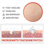 Acne Patch, Skin Clean Acne Pimple Moles Gram Wart Corns Spot Patch - Korvel