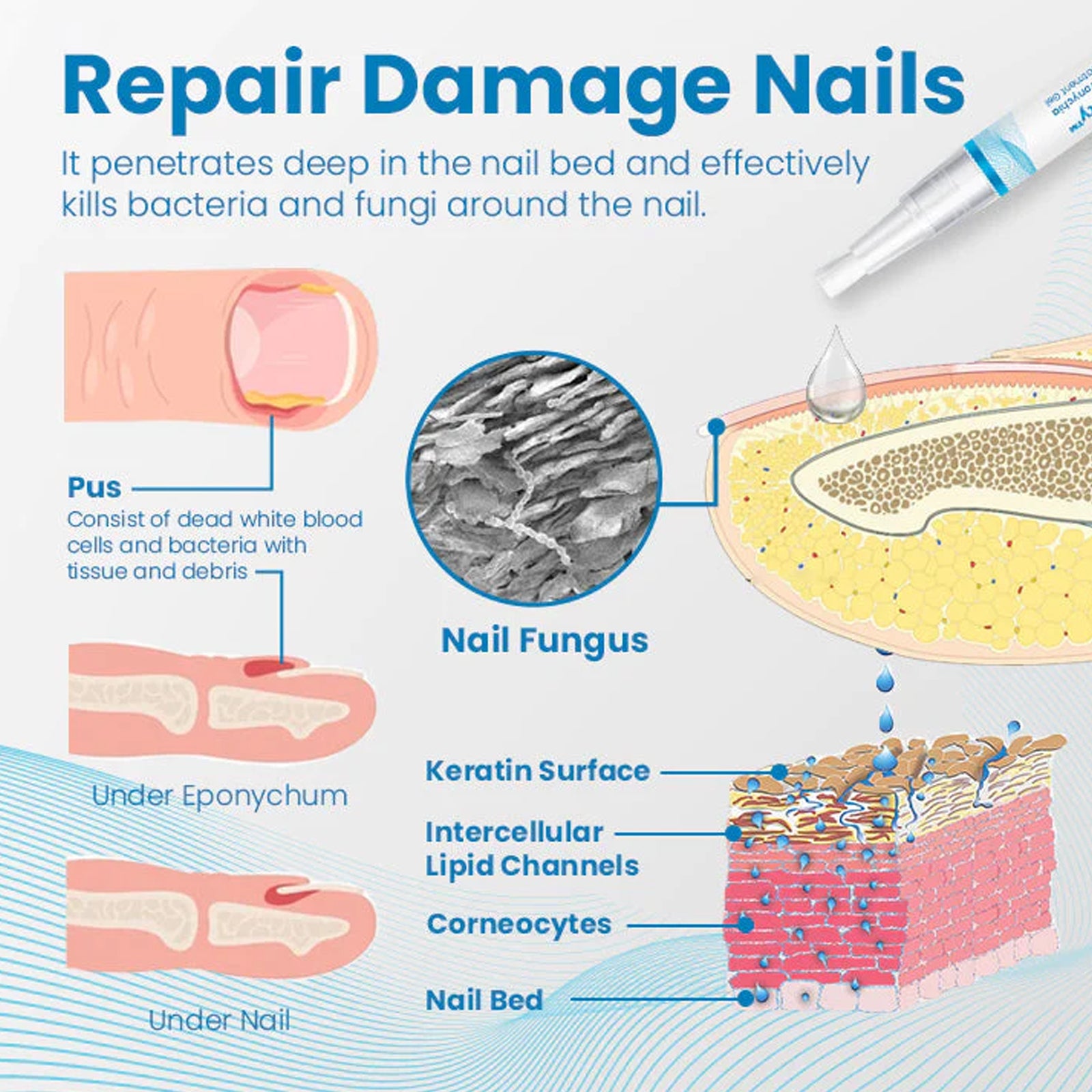 Anti-Paronychia Nail Repairing Gel, Repair Encased Rotten Nails Soft Nails Thickening Pain Relief Cleansing Care - Korvel